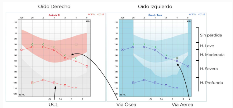 Como ler um audiograma